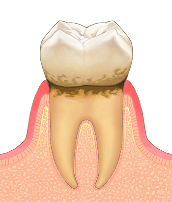 歯周病治療