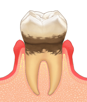 歯周病治療