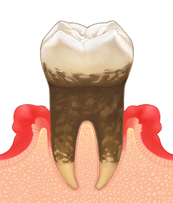 歯周病治療