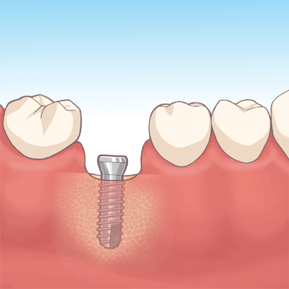 インプラント治療の流れ