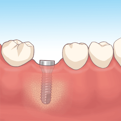 インプラント治療の流れ