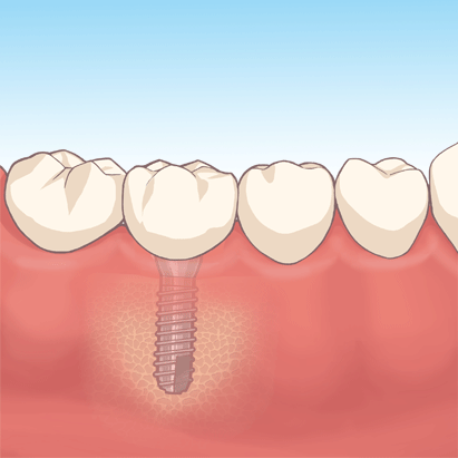 インプラント治療の流れ