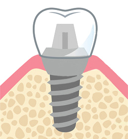 インプラント