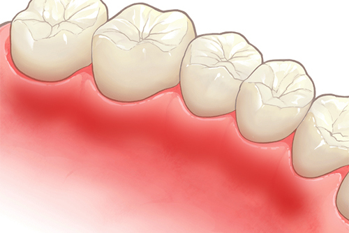 歯ぐきが腫れた