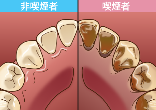 歯を白くしたい